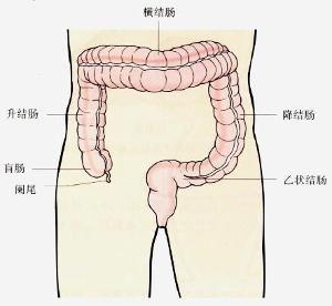 结肠扭转