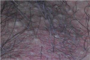 网状红斑萎缩性毛囊炎