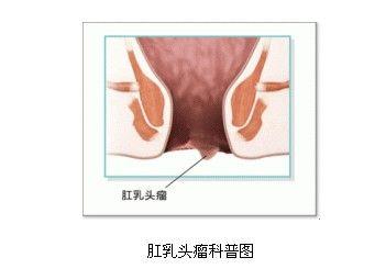 肛乳头炎