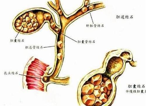 肝胆管结石