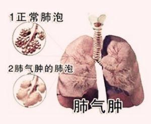 肺胀