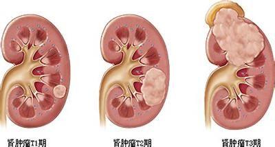 肾细胞癌
