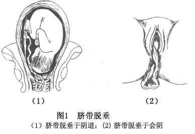 脐带脱垂