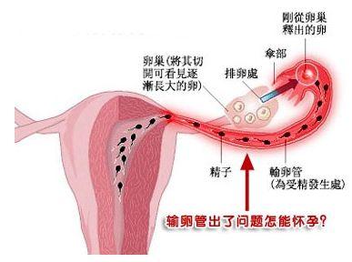 输卵管囊肿