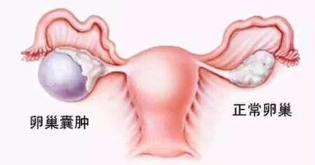 输卵管囊肿