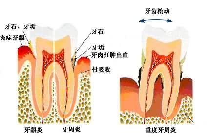青少年牙周炎
