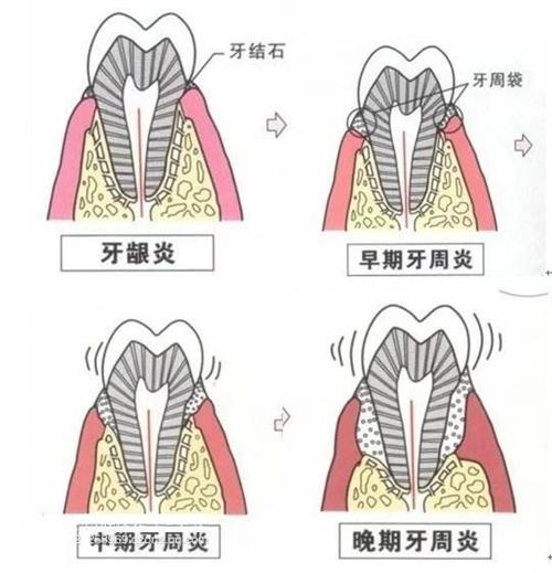 青少年牙周炎