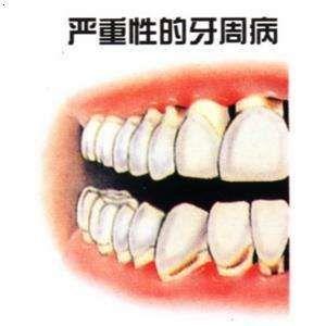 青少年牙周炎