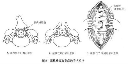 颈椎椎管狭窄症