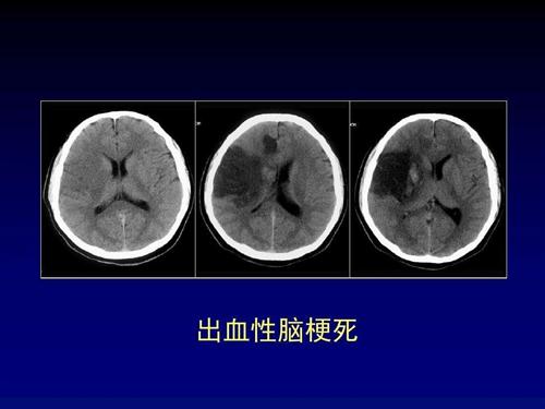 出血性脑梗死