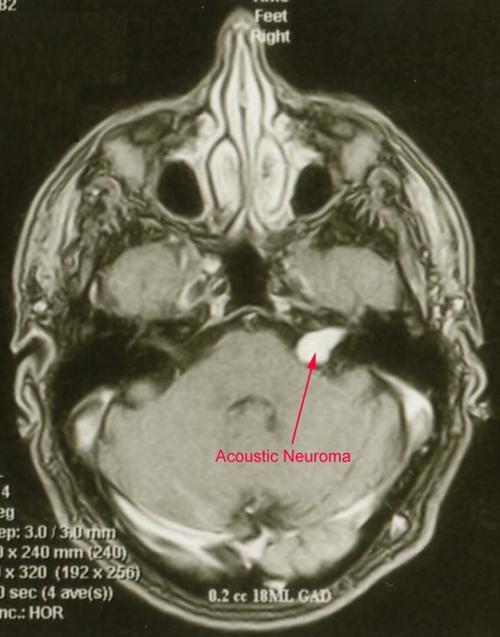 听神经鞘瘤