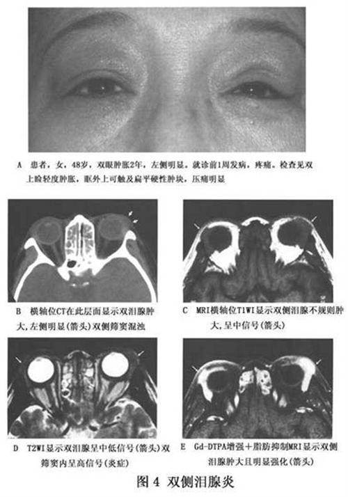 急性泪腺炎