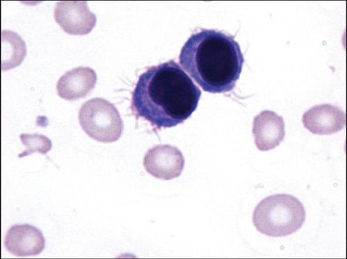 浆细胞白血病
