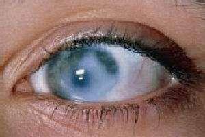 慢性闭角型青光眼