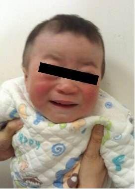 黏多糖贮积症