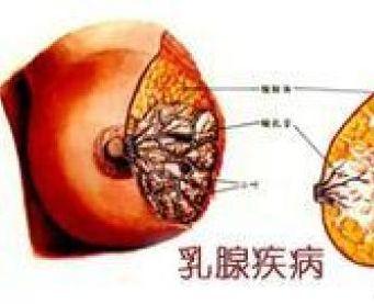 产褥期乳腺炎