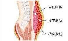 内脏性肥胖