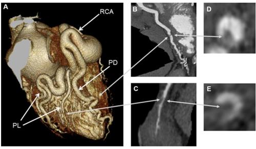 冠状动脉异常起源于肺动脉