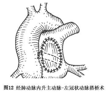 冠状动脉异常起源于肺动脉