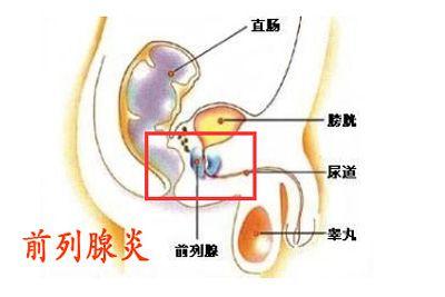 前列腺病