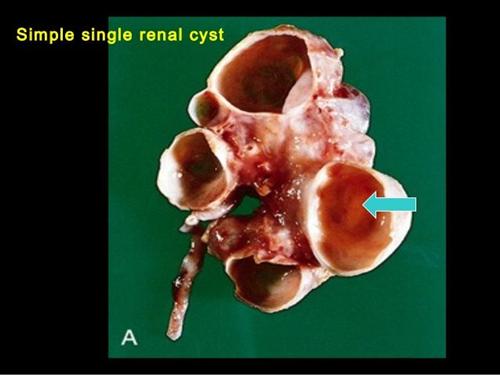 单纯性肾囊肿