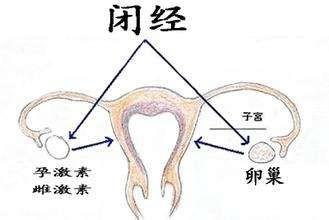 卵巢性闭经