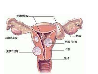 妊娠合并子宫肌瘤