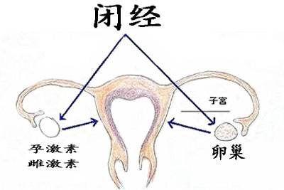 子宫性闭经