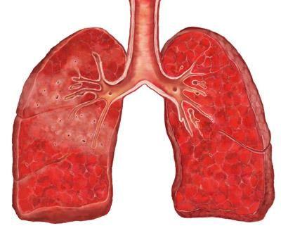 小儿支气管肺发育不全