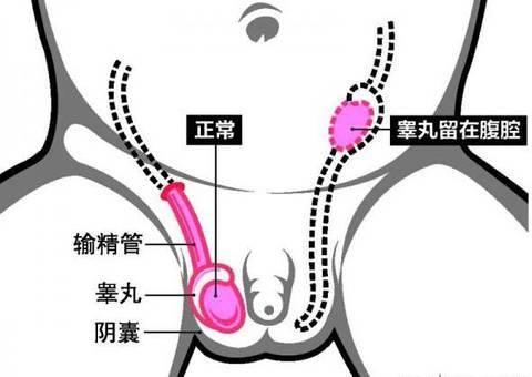 小儿隐睾