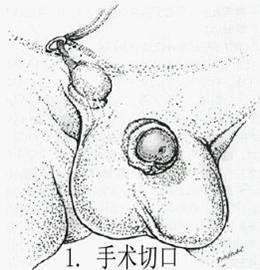 小儿隐睾