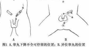 小儿隐睾