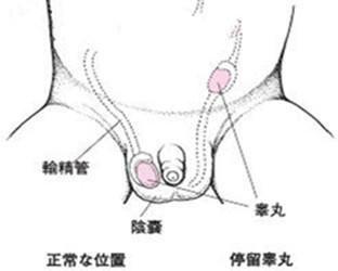小儿隐睾