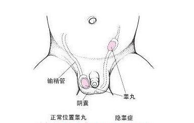 小儿隐睾