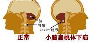 小脑扁桃体下疝畸形