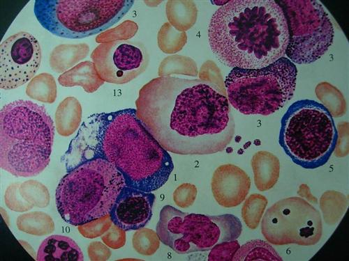 巨幼细胞贫血