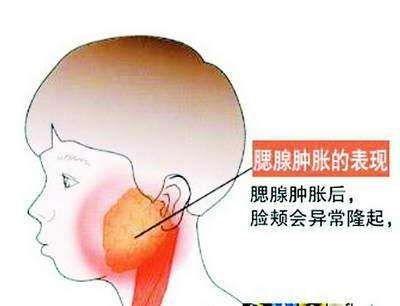 慢性化脓性腮腺炎