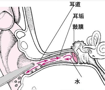 慢性外耳道炎