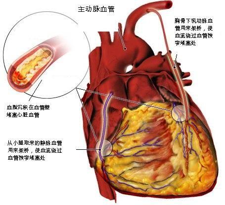 无症状型心肌缺血