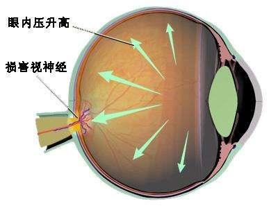 正常眼压性青光眼