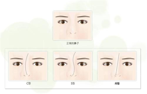 歪鼻