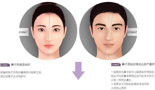歪鼻