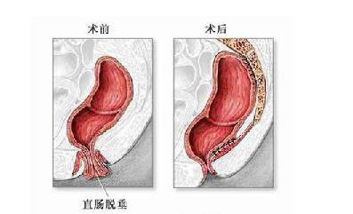 淋菌性肛门直肠炎