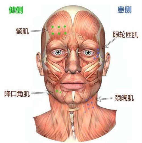 特发性面神经瘫痪