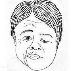 特发性面神经瘫痪