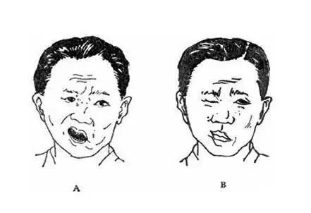 特发性面神经瘫痪