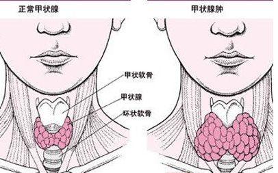 甲状腺微小癌