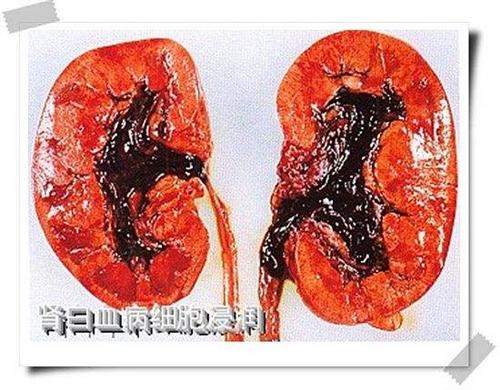 白血病细胞浸润
