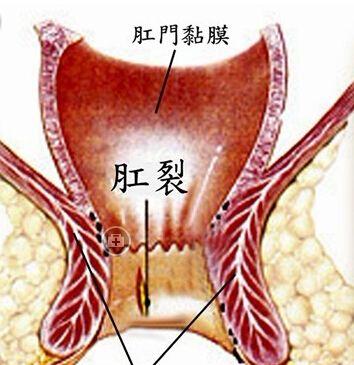 直肠肛管先天性疾病