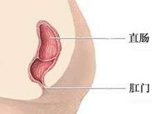 直肠肛管先天性疾病